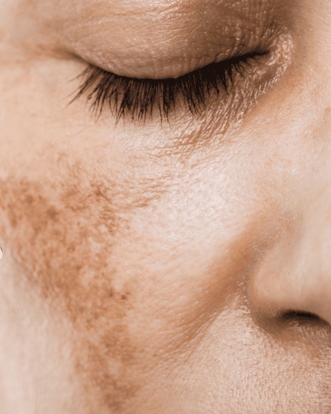 Pigmentation & Discolouration