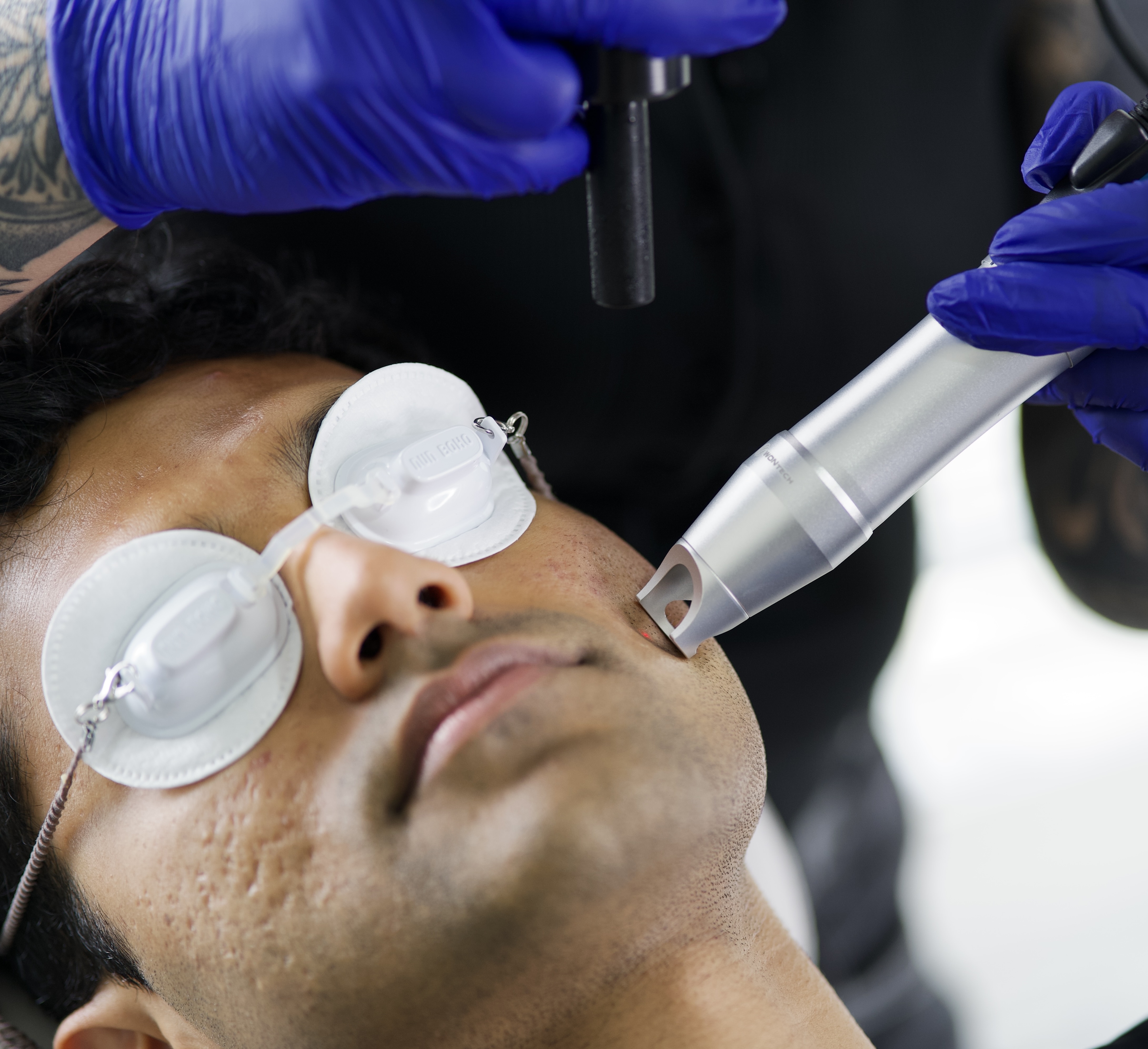 Scar & Stretch Mark Reduction